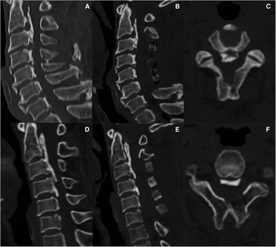 Analysis between preoperative cervical radiographic parameters represented by the K-line tilt and the short-term prognosis of laminoplasty for posterior longitudinal ligament ossification: A retrospective study